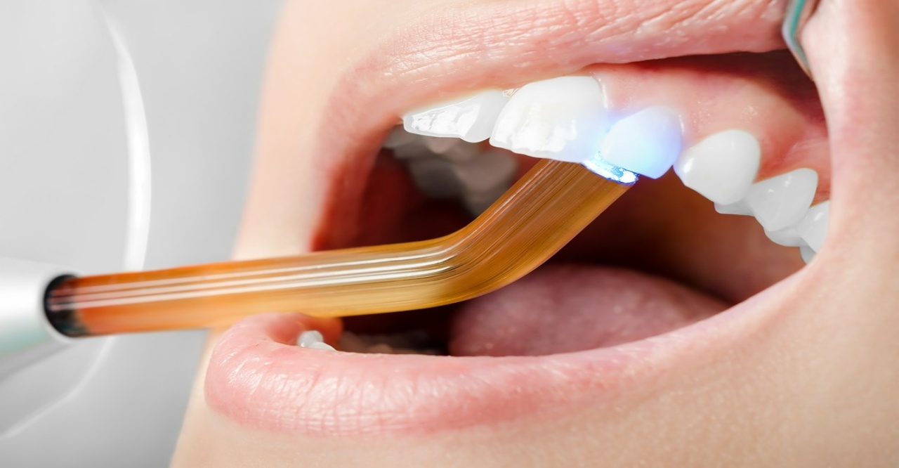bolding zębów u stomatologa